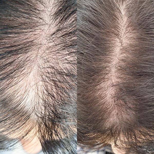 Плазмоліфтинг волосся - лікування алопеції Київ