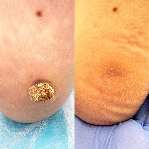Удаление бородавки Киев - фото До/После заживления