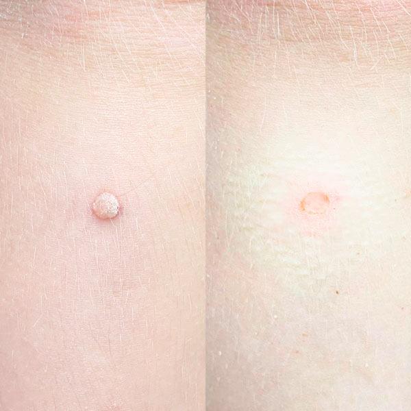 Лазерне видалення бородавки Київ