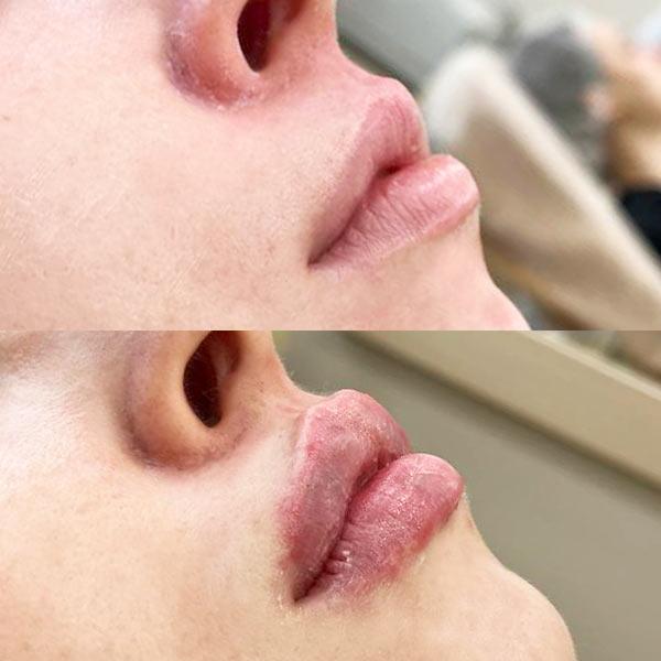 Збільшення губ Київ