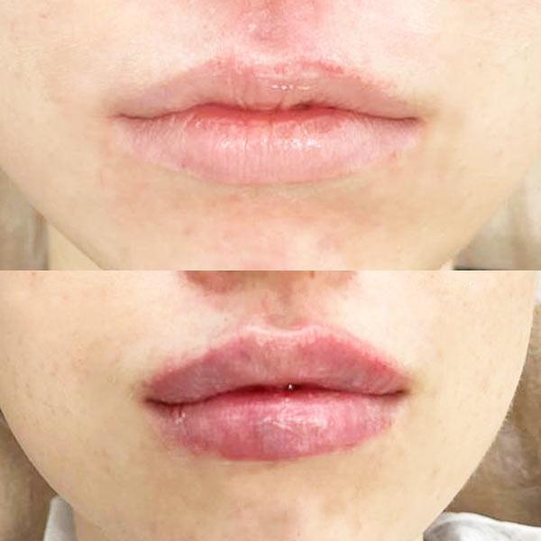 Контурна пластика губ - Збільшення губ Київ