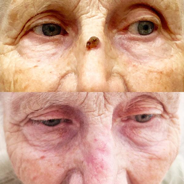 Хирургическое удаление кожного рога Киев