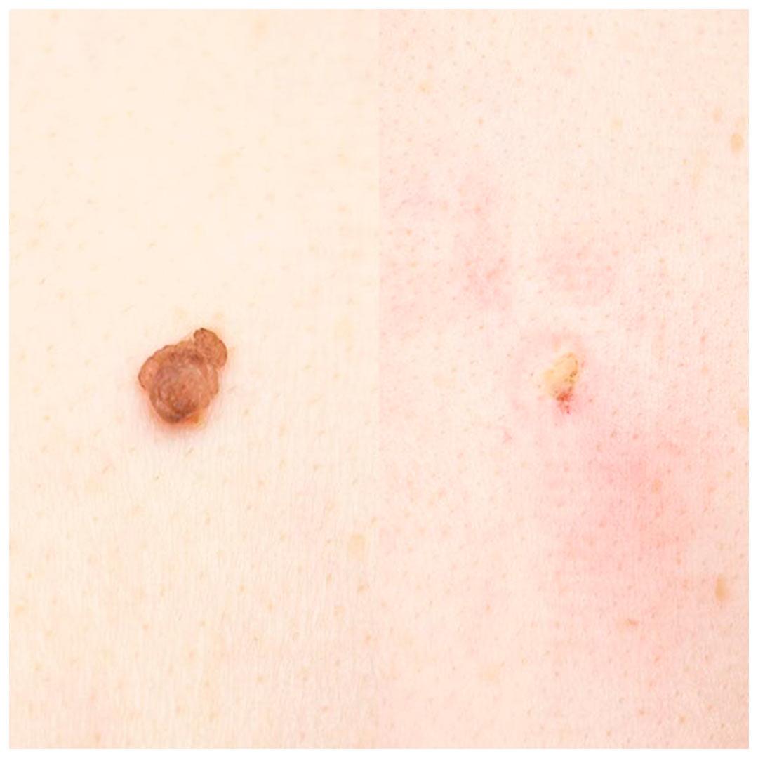 Радіохвильове видалення родимок Київ