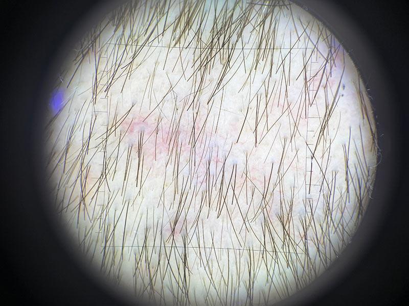 Трихоскопия Фото После лечения