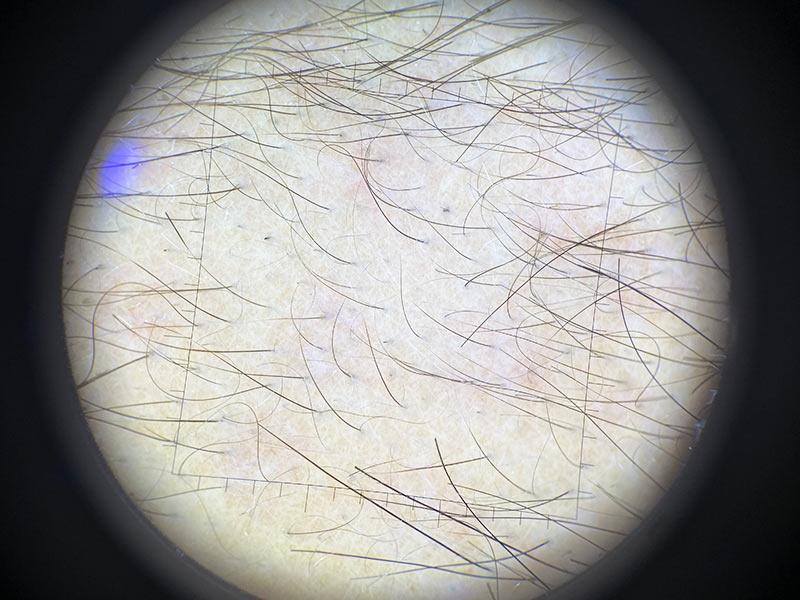 Трихоскопия Фото До лечения