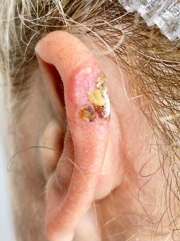 Видалення БКК методом Mosh Київ