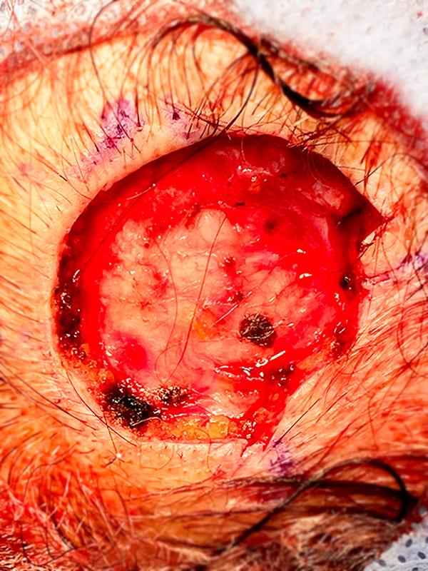 Видалення злоякісного утворення методом Mosh Київ