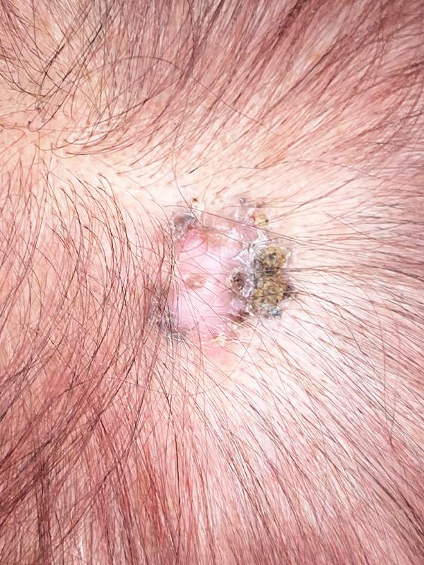 Видалення Базаліоми методом Mosh Київ