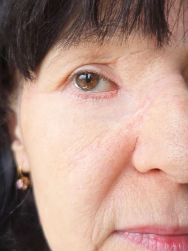 Результат удаления БКК на веке Киев Результат удаления БКК на веке Киев