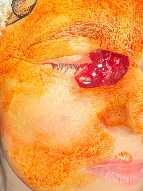 Удаление базалиомы методом MOHS Киев Удаление базалиомы методом MOHS Киев