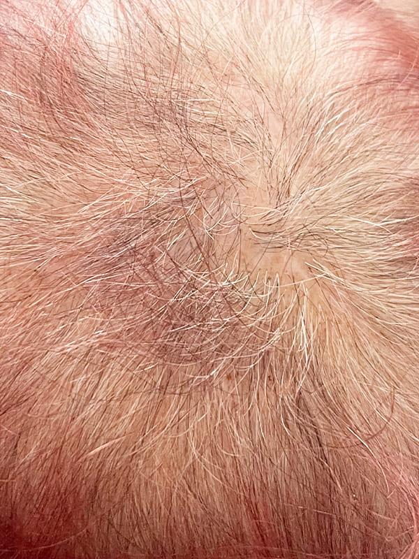 Удаление Базалиомы методом Mosh До После Киев Удаление Базалиомы методом Mosh До После Киев