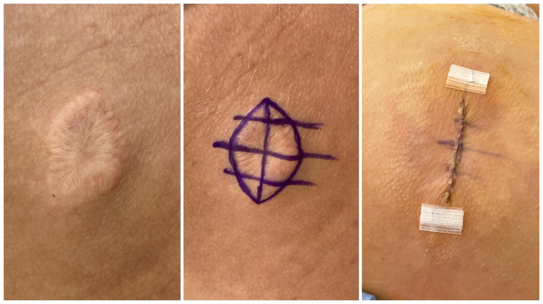 Хирургическая пластика рубца Киев - фото после операции