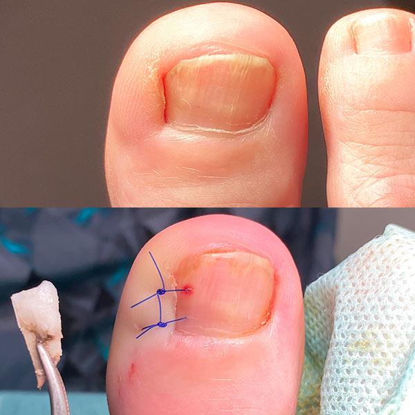 Хірургічне видалення врослого нігтя Київ - фото відразу після операції