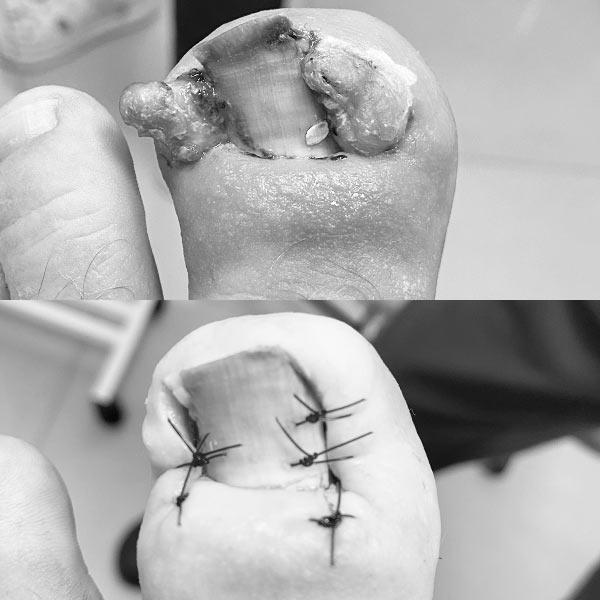 Хірургічне лікування врослого нігтя 4 стадії Київ - фото відразу після операції