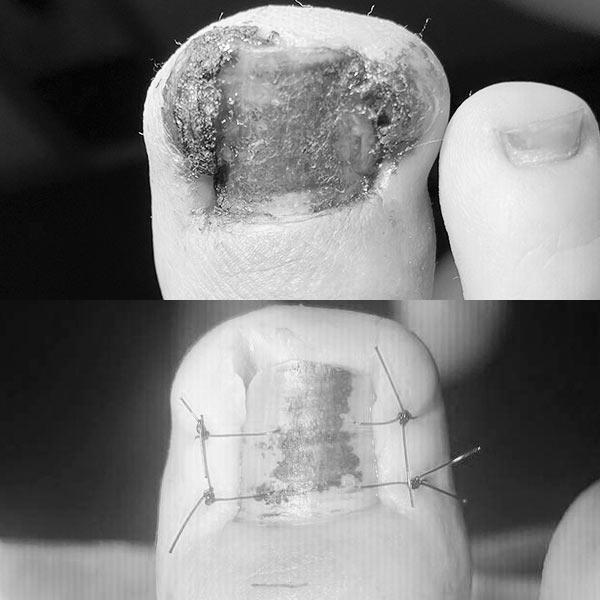 Гипергрянуляция ногтевого валика – Хирургическое лечение онихокриптоза 4 стадии Киев