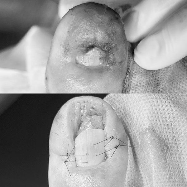 Хірургічне лікування врослого нігтя 4 стадії Київ - фото відразу після операції