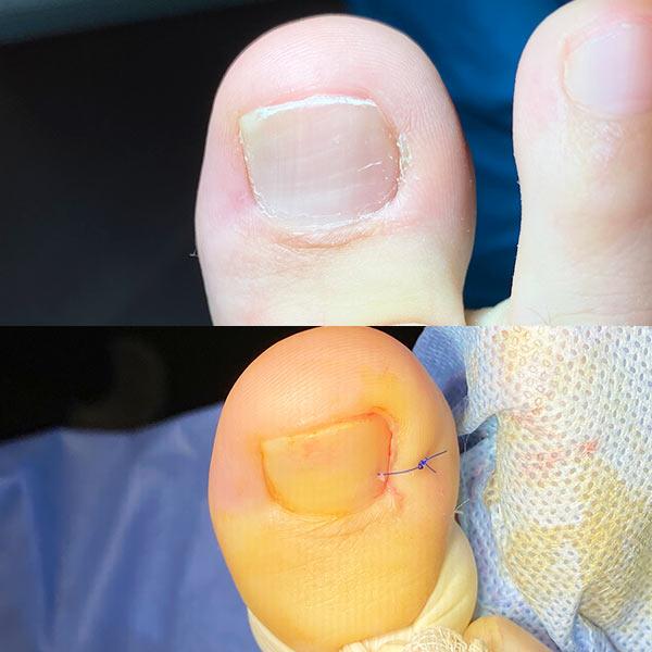 Хірургічне лікування врослого нігтя Київ - фото відразу після операції