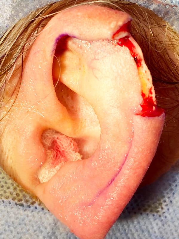 Удаление базалиомы До После - Киев Удаление базалиомы До После - Киев