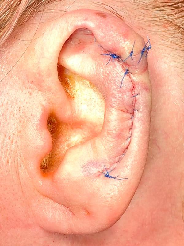 Удаление базалиомы методом Mosh Киев Удаление базалиомы методом Mosh Киев