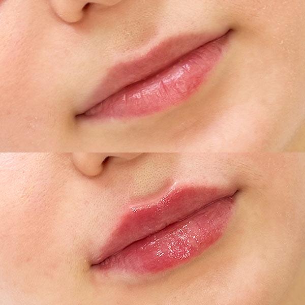 Контурна пластика - збільшення губ Київ