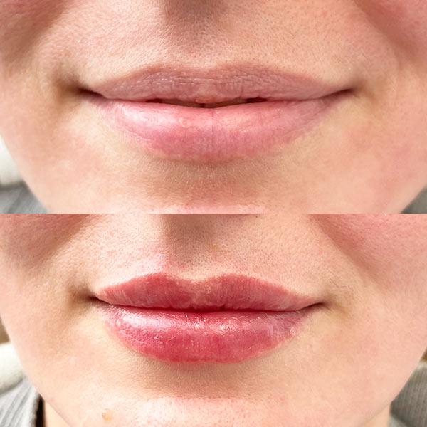 Контурна пластика губ Київ