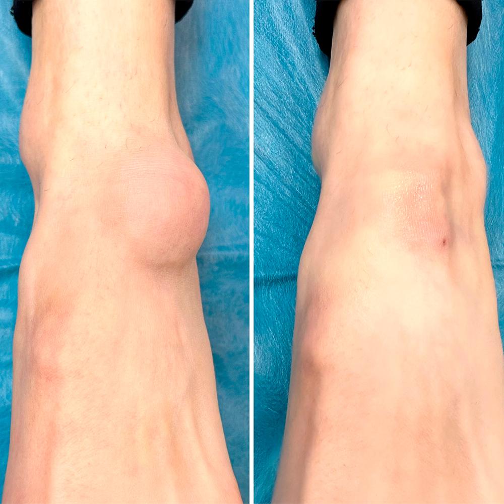 Видалення гігроми