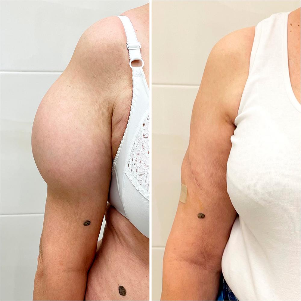 Удаление большой липомы