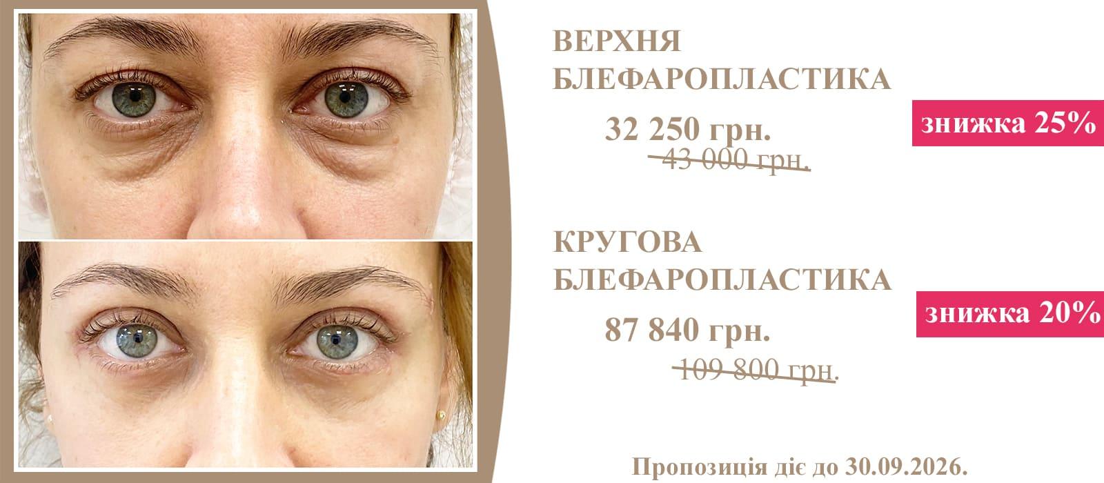 ВЕРХНЯ БЛЕФАРОПЛАСТИКА зі знижкою 25%