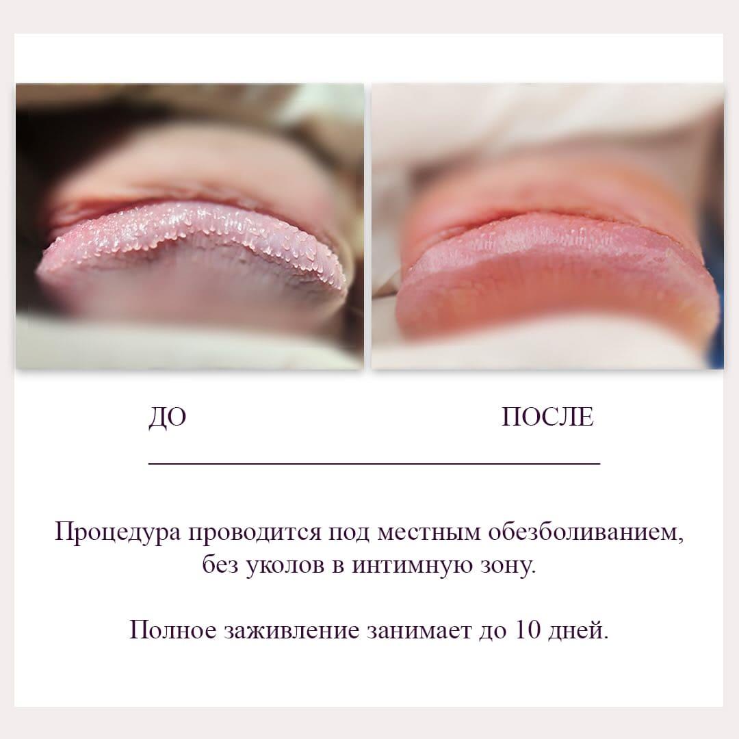 мужские папулы Киев удаление мужских папул Киев
