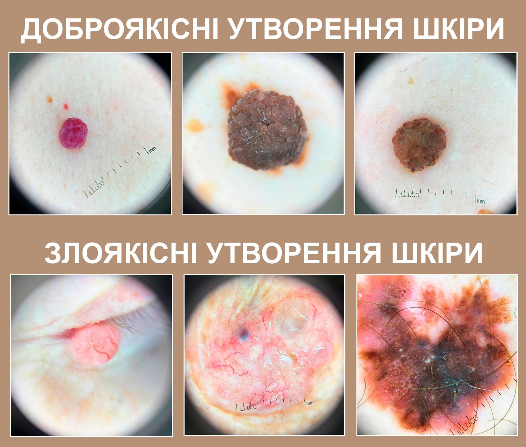 Цифровая дерматоскопия новообразований кожи в Киеве