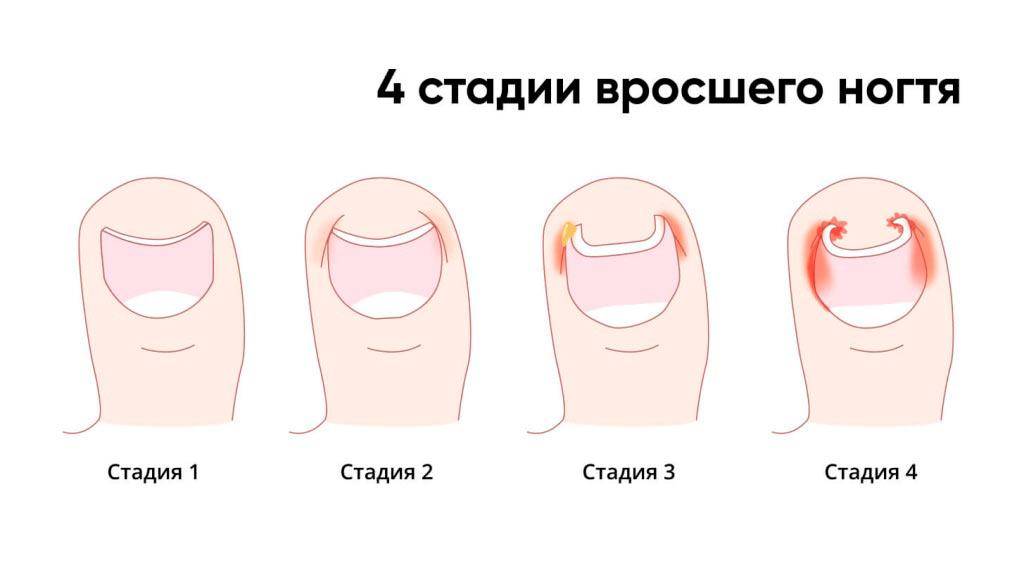 Стадии врастания ногтевой пластины Стадии врастания ногтевой пластины